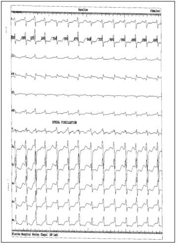 短暂房颤心电图