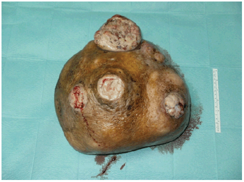 罕见病例 | 重达7.15kg的乳腺肿瘤,你见过吗?