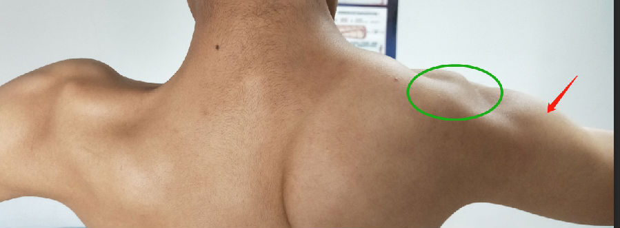 红箭头指的是三角肌,相对三角肌肌肉无明显萎缩,而绿色圈内的肩胛带肌