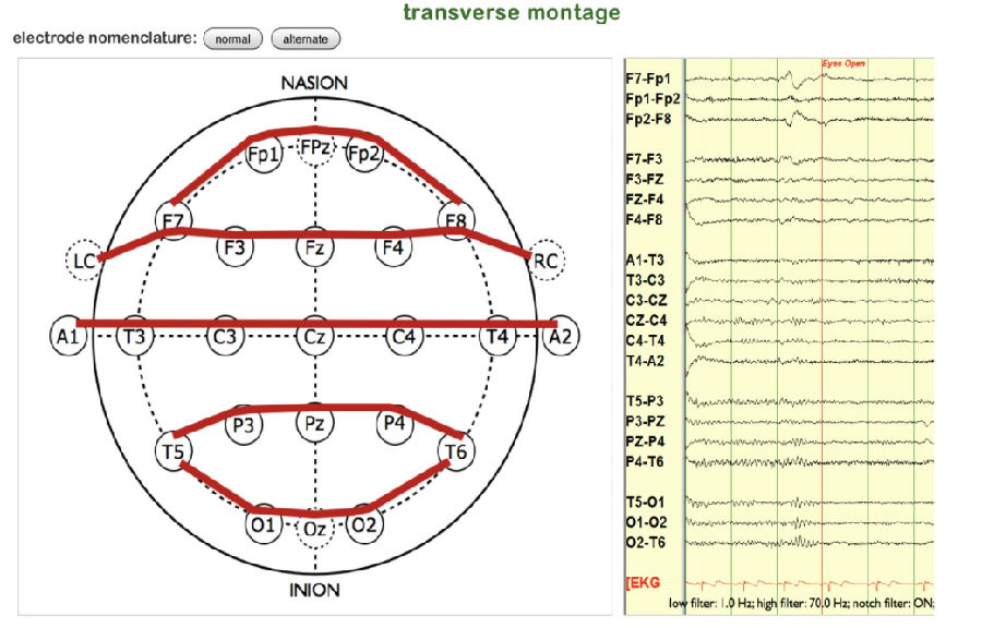 正常篇最一目了然的成人脑电图图谱上一键收藏