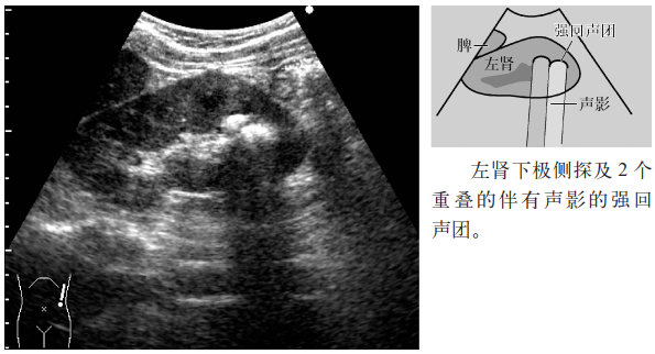 肾结石,输尿管结石超声表现一览 | 临床实战