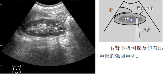 肾结石,输尿管结石超声表现一览 | 临床实战