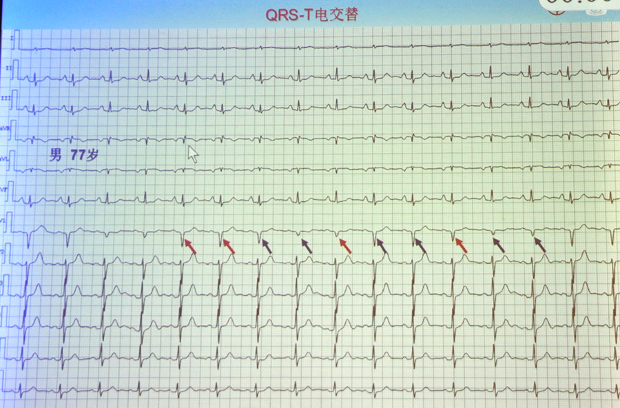 2. 提示严重高钾血症的心电图表现(窦室传导,并结合临床实验室检查).