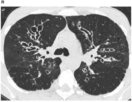 图17:囊性肺纤维化患者ct显示弥漫性,囊性支气管扩张 胸膜病变
