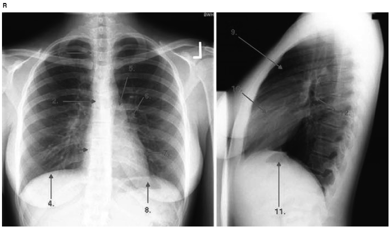 左侧膈肌(胃泡);9.胸骨后透亮区;10.右心室;11.