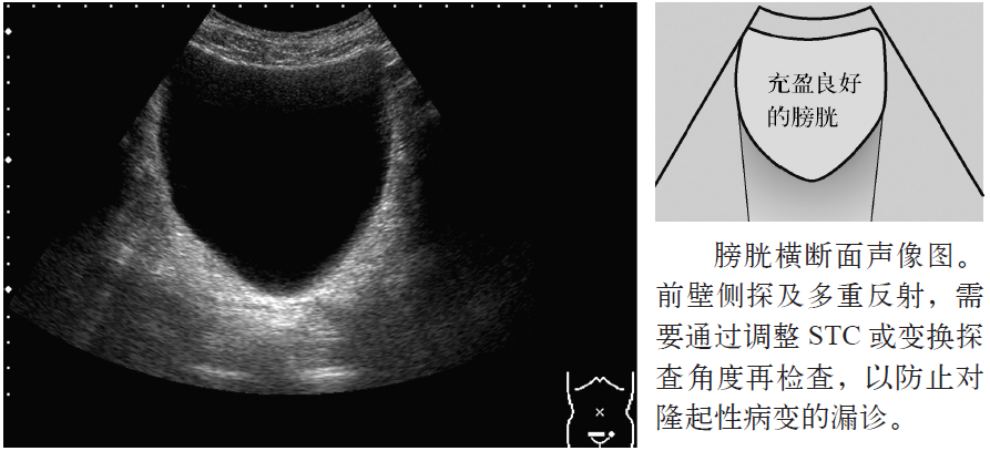 膀胱充盈时横断面声像图