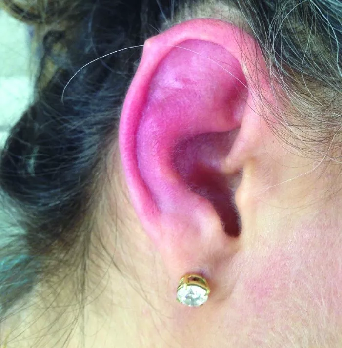 耳:复发性多软骨炎最常见典型特征是耳廓破坏,表现为耳廓变色,压痛或