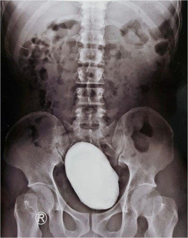 腹部平片显示一巨型圆形钙化盆腔结石