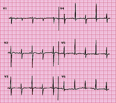 心电图检查 心包填塞的心电图可出现窦性心动过速,低电压(心包填塞的