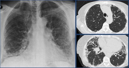 胸疾病胸片表现之肺间质