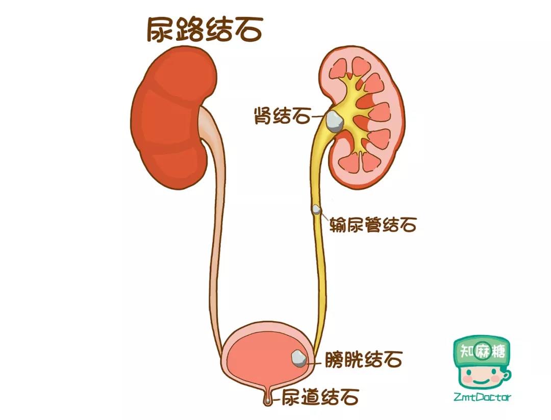 肾结石手术医保给报销不 肾结石微创医保报销比例