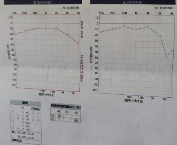 纯音测听:显示双耳高频听力下降