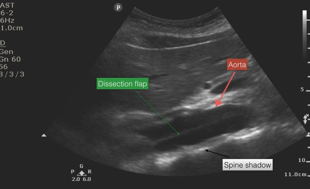 主动脉夹层患者的超声心动图影像(绿色箭头:将主动脉腔分为两部分