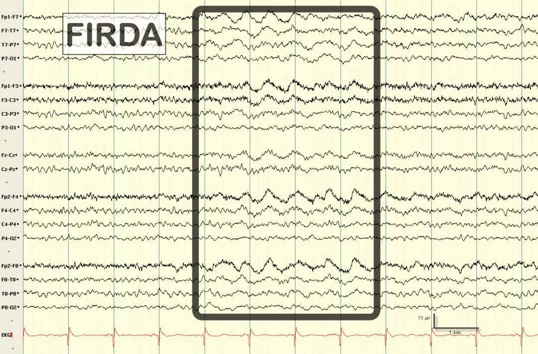 成人口对口吹气频率_伪差篇 最一目了然的成人脑电图图谱丨一键收藏