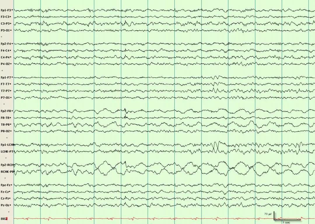 成人口对口吹气频率_伪差篇 最一目了然的成人脑电图图谱丨一键收藏