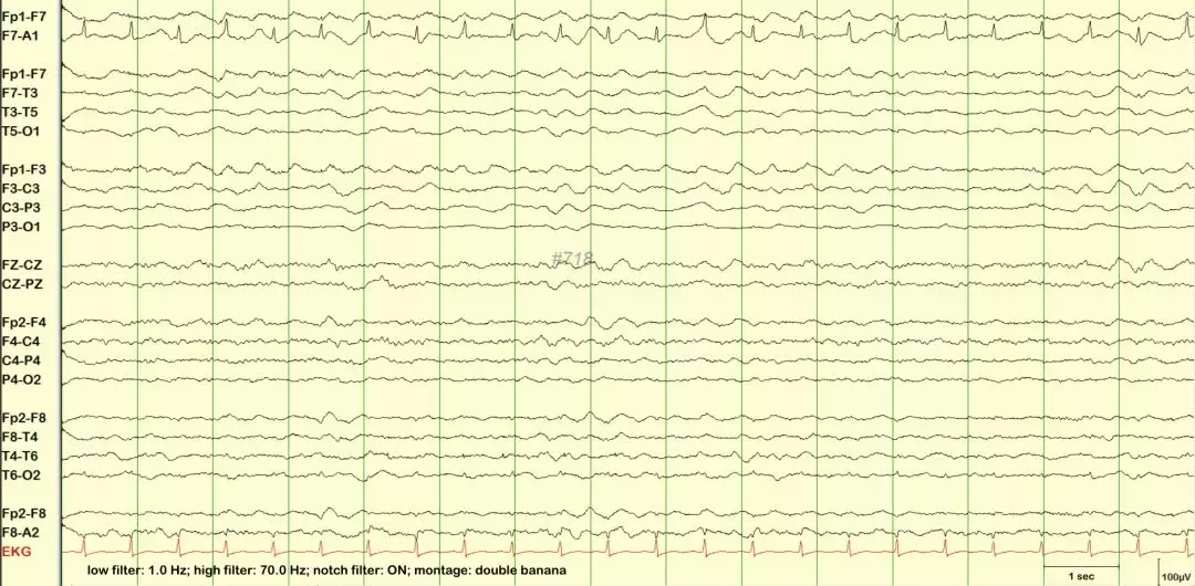 异常篇:最一目了然的成人脑电图图谱丨一键收藏