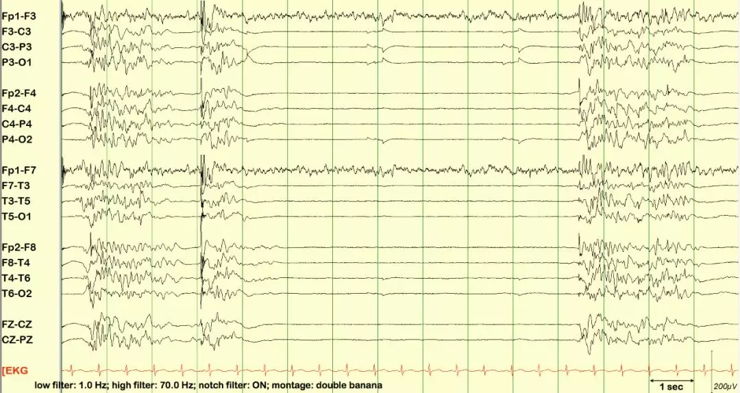 异常篇:最一目了然的成人脑电图图谱丨一键收藏