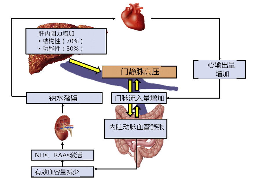 一文读懂:肝硬化门脉高压的发病机制|临床