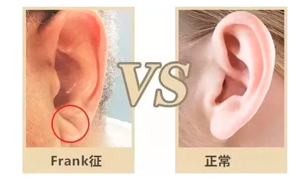 高以翔 图片来源于网络   frank征与心血管疾病   frank征,亦称耳垂