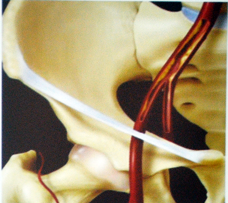 股动脉穿刺部位解剖图