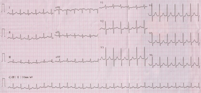 典型室上性心动过速心电图