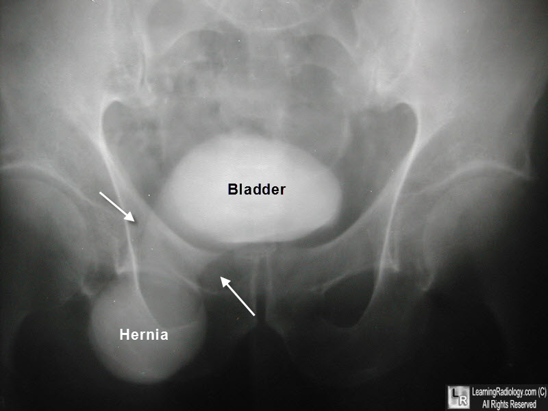 膀胱疝气的分类及影像学表现 | 临床实战