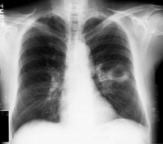 肺脓肿与脓胸需要这样鉴别│临床必备