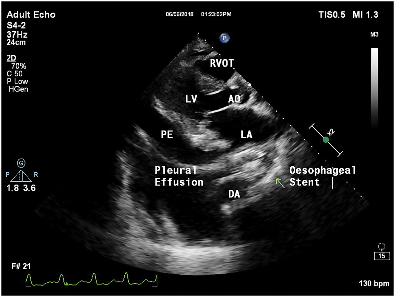 经胸超声心动图检查显示,左心房后有金属阴影,即食管支架(图2,图3)