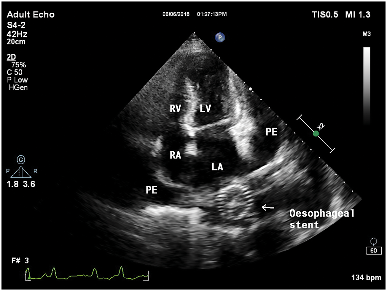经胸超声心动图检查显示,左心房后有金属阴影,即食管支架(图2,图3)