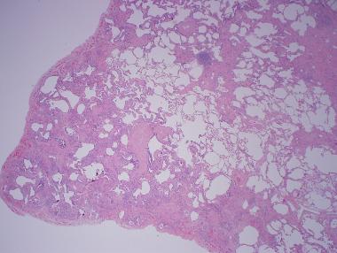 蜂窝组织炎症是怎么引起的 1590542672888783.jpg