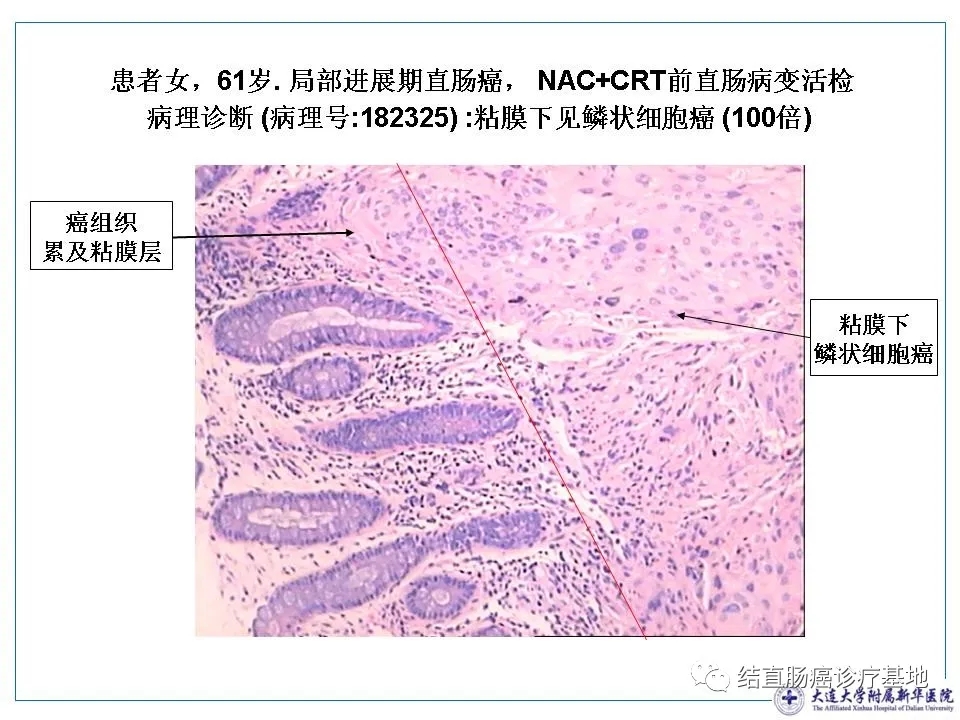 什么是进展期结肠癌 1596695956518609.jpg