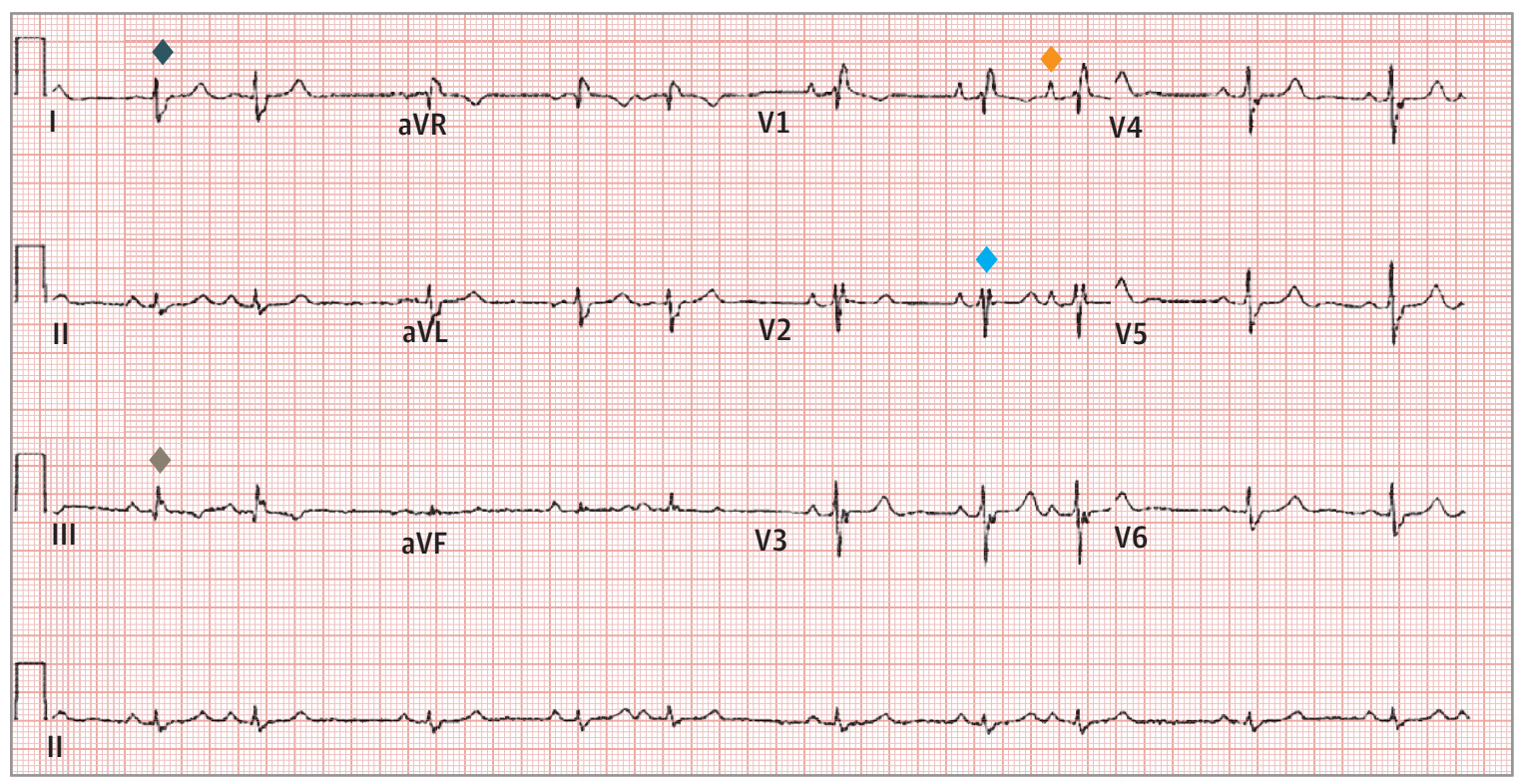 先天性心脏病,心电图上能看出什么?