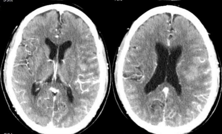 什么是黑色素瘤病 1604632686994687.jpg