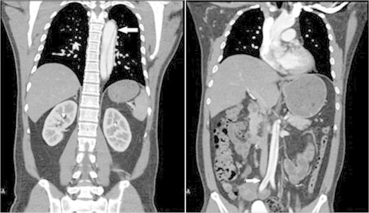 什么是主动脉夹层怎么引起的 1611301702421495.jpg