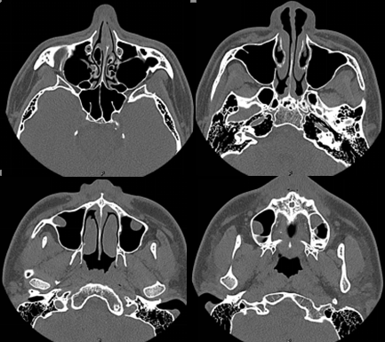 为病例三的鼻窦ct,可见双侧上颌窦囊肿,双侧筛窦粘膜增厚,双侧下