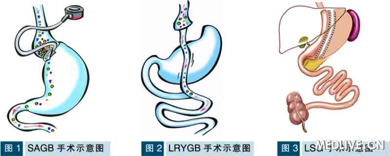 治疗肥胖症和糖尿病腹腔镜减重手术适宜人群和术式选择