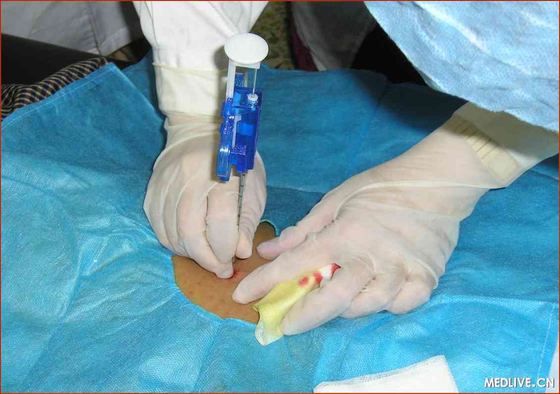 早期肾活检对狼疮性肾炎十分有益