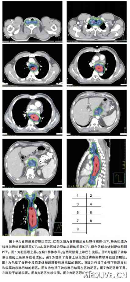 食管癌放疗靶区定义
