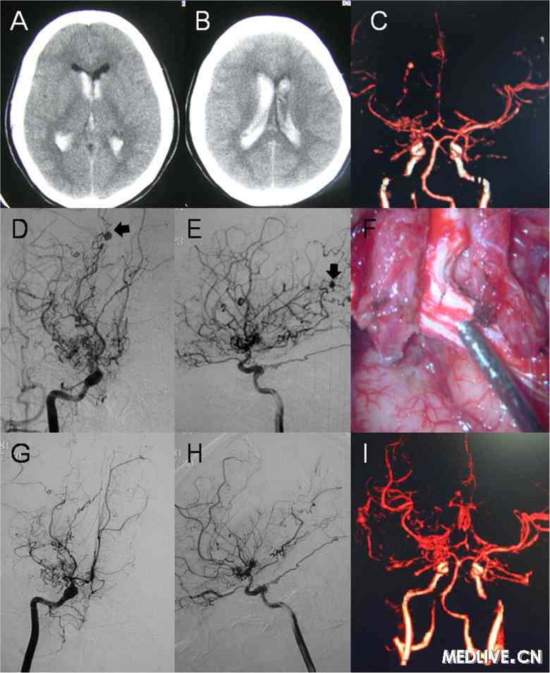 cerebrovasc dis.2012,34:305)