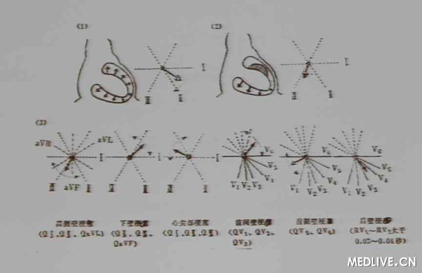 心电图对心梗部位的定位