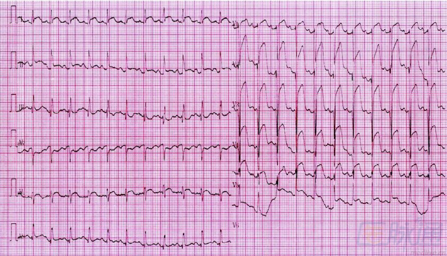 心包炎心电图特征图片