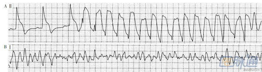 急性心肌損傷型st段抬高出現室性心動過速惡化為心室顫動的心電圖