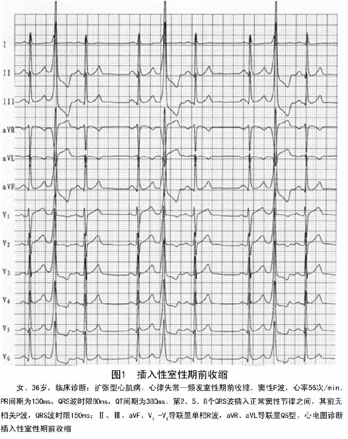 卢喜烈:图解室性期前收缩的代偿间歇