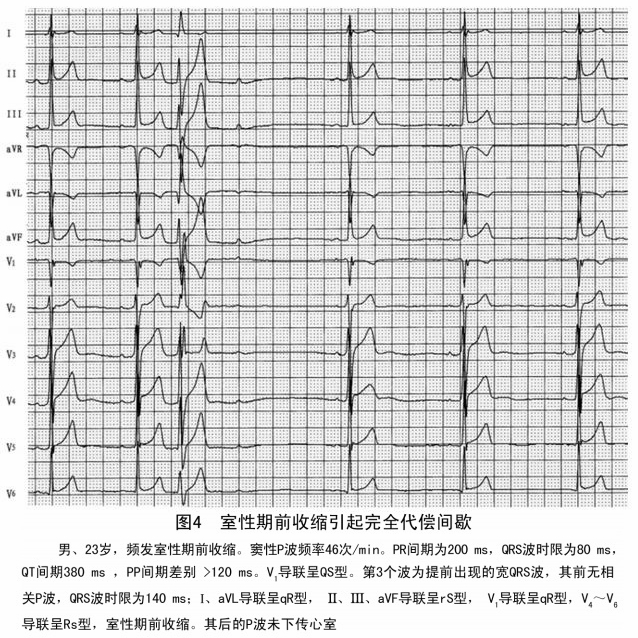 房性早搏的9种代偿间期