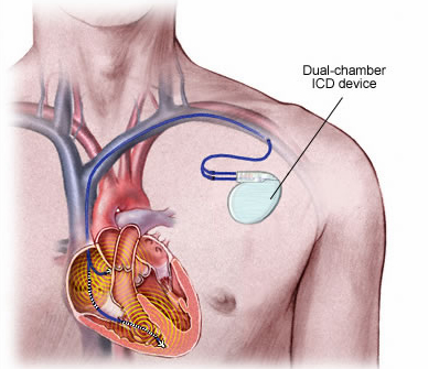 2014hrsaccaha关于在临床试验未纳入或不典型患者中植入式心律转复