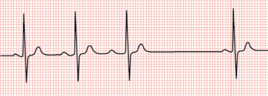 ii度房室传导阻滞(莫氏i型)