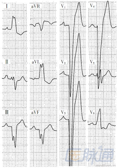 高尖t波心电图表现图片