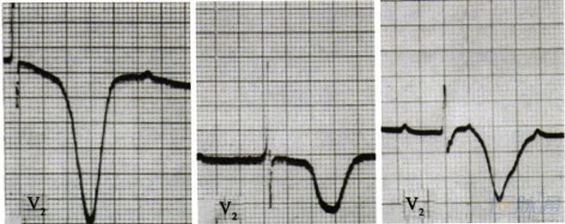 【基础知识】巨大倒置t波图解及临床意义 - 心血管内科讨论版 - 爱爱