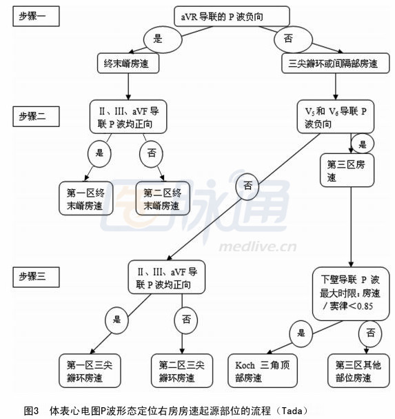 3.1 终末嵴起源的 房速