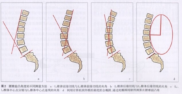 腰椎前凸角度图片